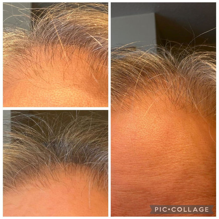 Denise's hairline in weekly photos