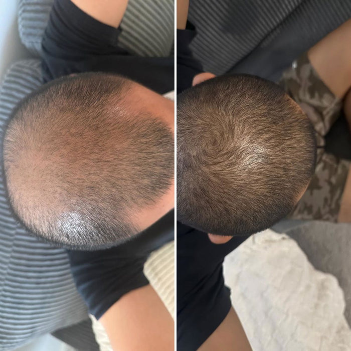 The crown of her husband's head, thin in the first photo and fuller in the second