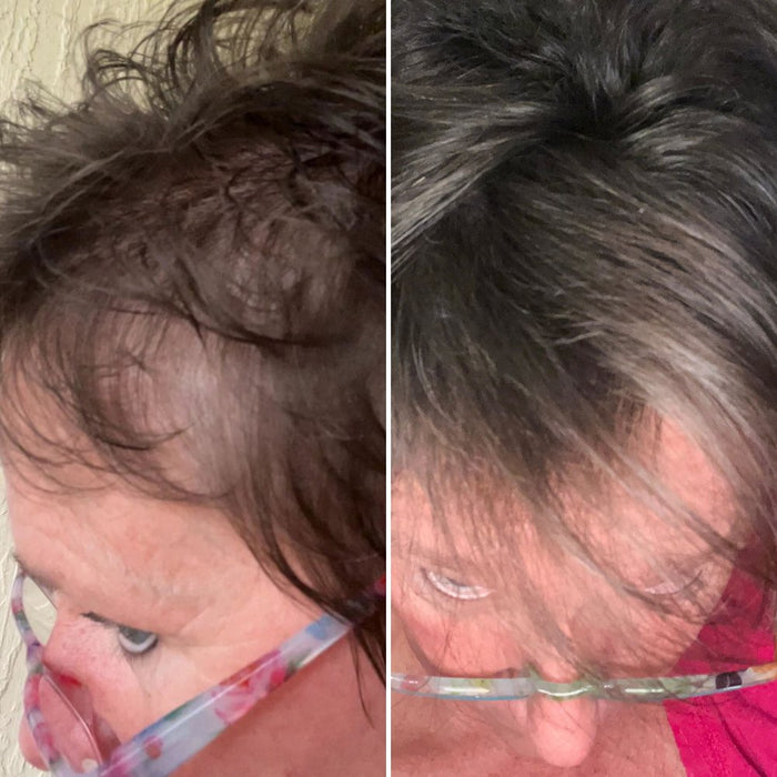 The top of Kim's head in May, thin, and later, fuller
